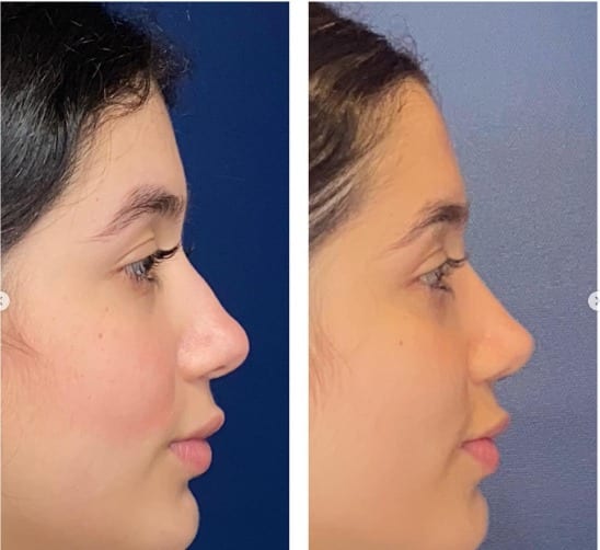 Rinoplastia caso 20 — antes y después